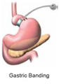 Gastric By-pass Surgery in Indraprastha Apollo Hospitals Delhi, India