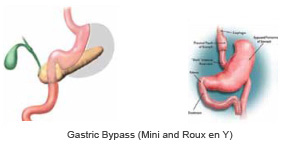 Obesity Treatment in Indraprastha Apollo Hospitals Delhi, India