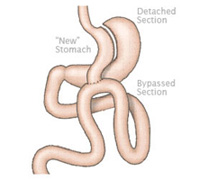 Bariatric Treatment in Indraprastha Apollo Hospitals Delhi, India